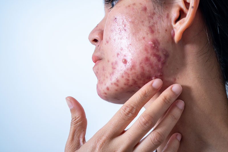 Effective Acne Scar Treatment in Delhi for Smoother Skin Texture