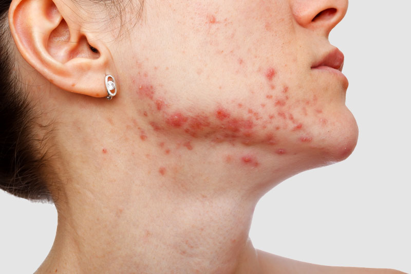Effective Treatments for Minimizing Acne and Acne Scars