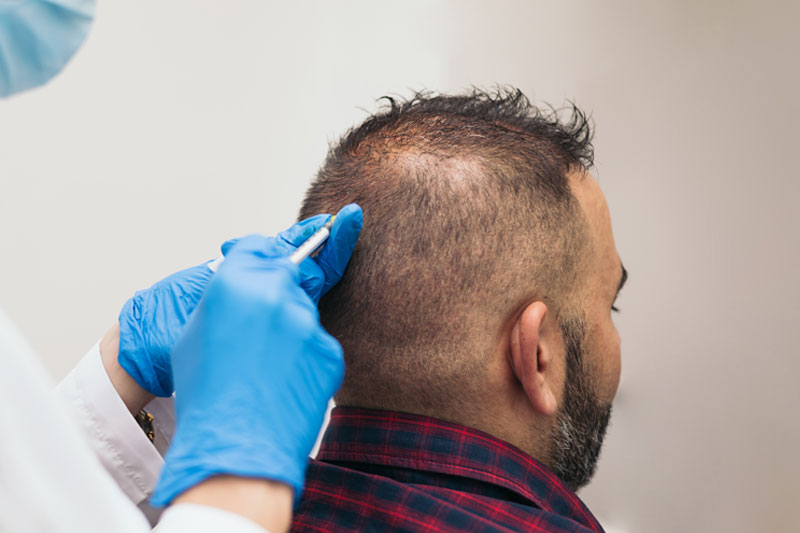 PRP Treatment in Delhi or Platelet-rich plasma – Does the cure for hair loss lie within our blood?