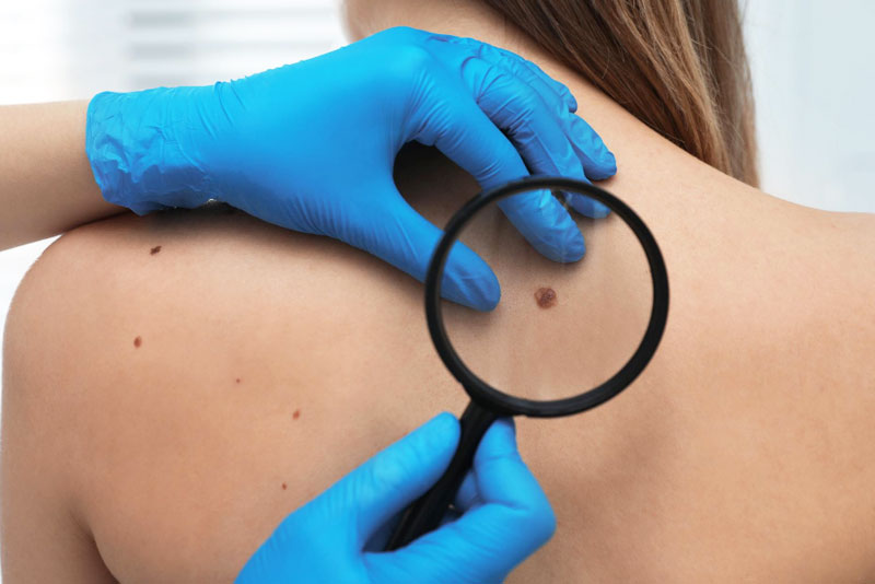 Skin Tag Removal in Delhi : Dermatologist-Approved Solutions for Skin Tags