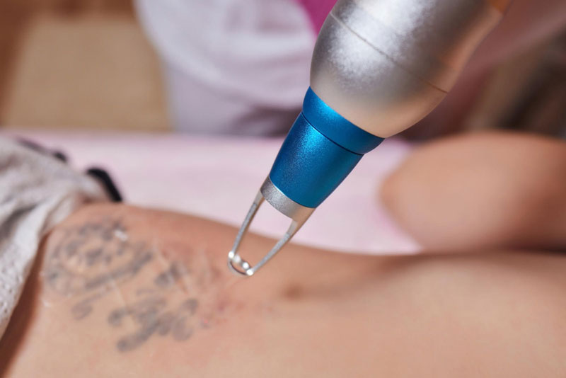 Key Things to Consider Before Choosing Tattoo Removal Treatment in Delhi