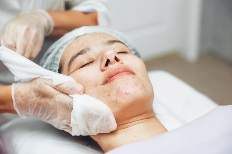 Achieve Clear, Scar-Free Skin with the Best Acne Treatment in Delhi