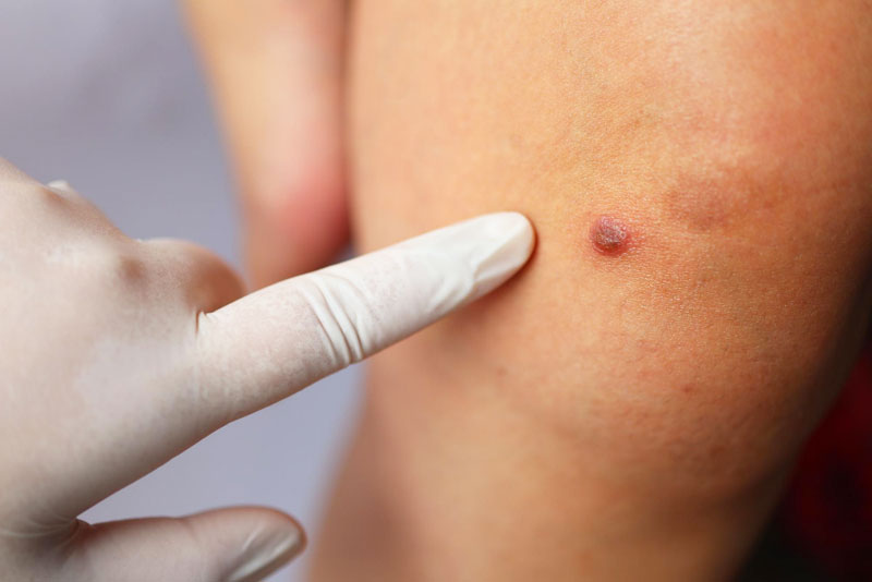 Complete Guide to Skin Tag Removal in Delhi by Expert Dermatologists