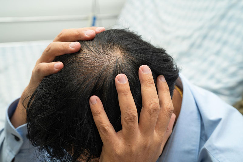 Hair Loss Treatment in Delhi: A Dermatologist’s Guide to Causes, Early Signs & Treatment