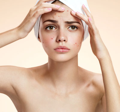 Acne Specialist in Delhi