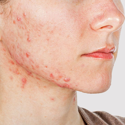 Acne Treatment Procedures