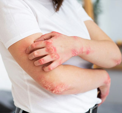Eczema Treatment In Delhi