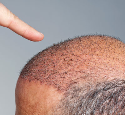 Hair Transplantation Cost in Delhi