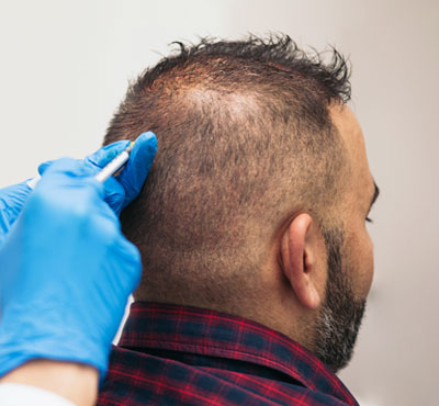Hair Treatment in Delhi