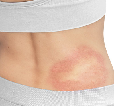 Hives Rash Treatment in Delhi