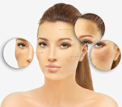 laser Pigmentation Treatment in delhi
