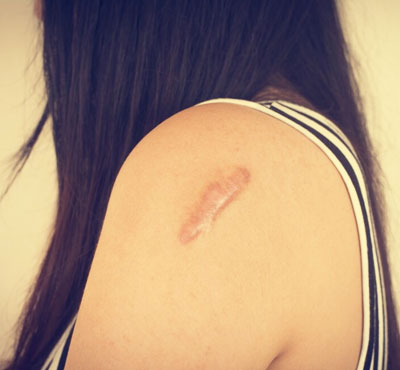 keloid treatment in delhi