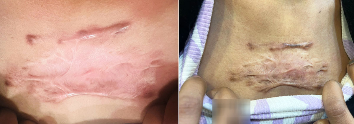 keloid treatment near me