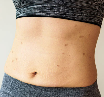 Laser Stretch Mark Removal Delhi