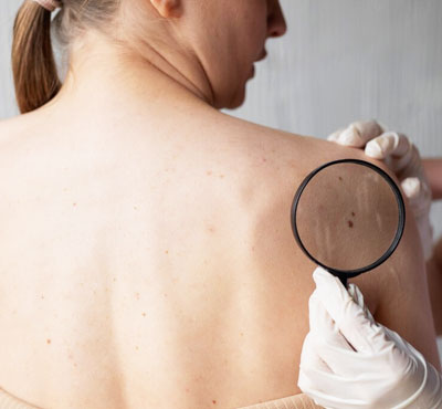 Mole Removal Treatment in Delhi