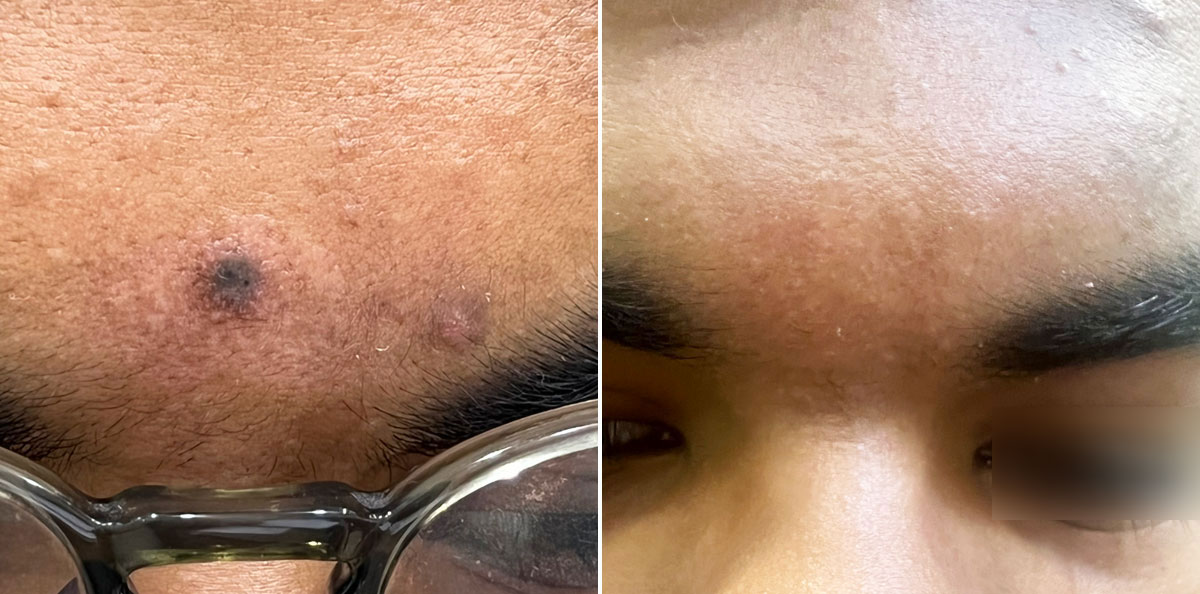 Mole removal after 1 year