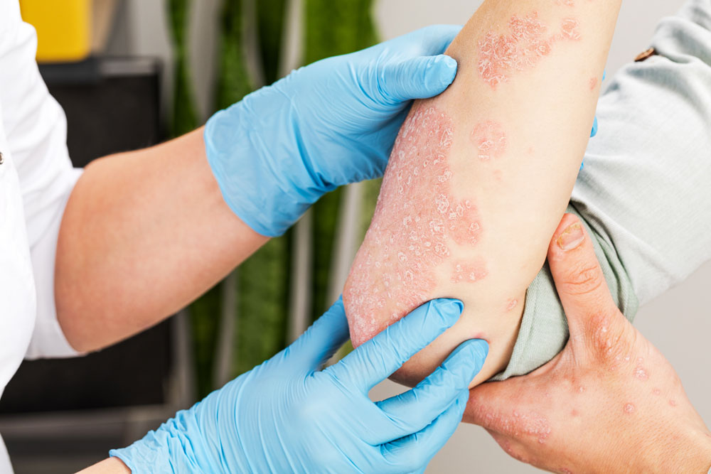 Psoriasis Treatment in Delhi