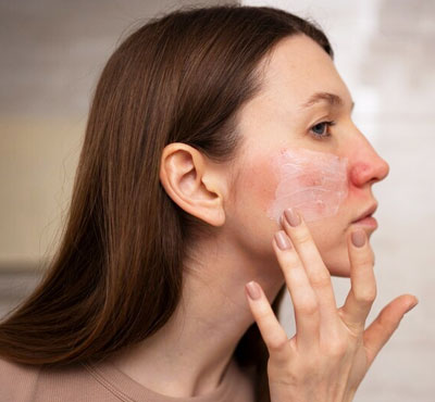 Rosacea Treatment in Delhi