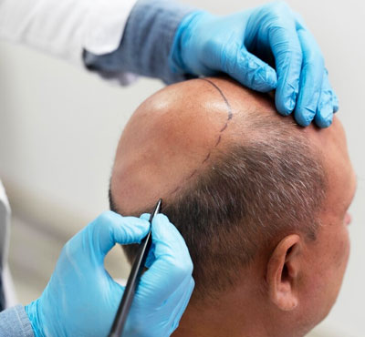 Scalp Thread Treatment in Delhi