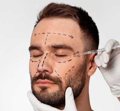 PDO Thread Lift Treatment in Delhi, Non Surgical Face Lift In Delhi