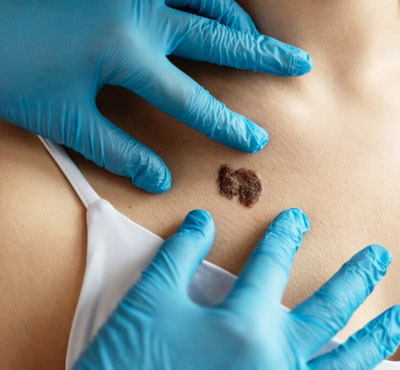 Skin Cancer Treatment in Delhi