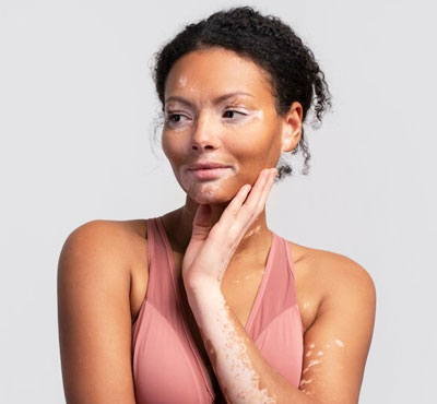 Vitiligo Surgery in Delhi